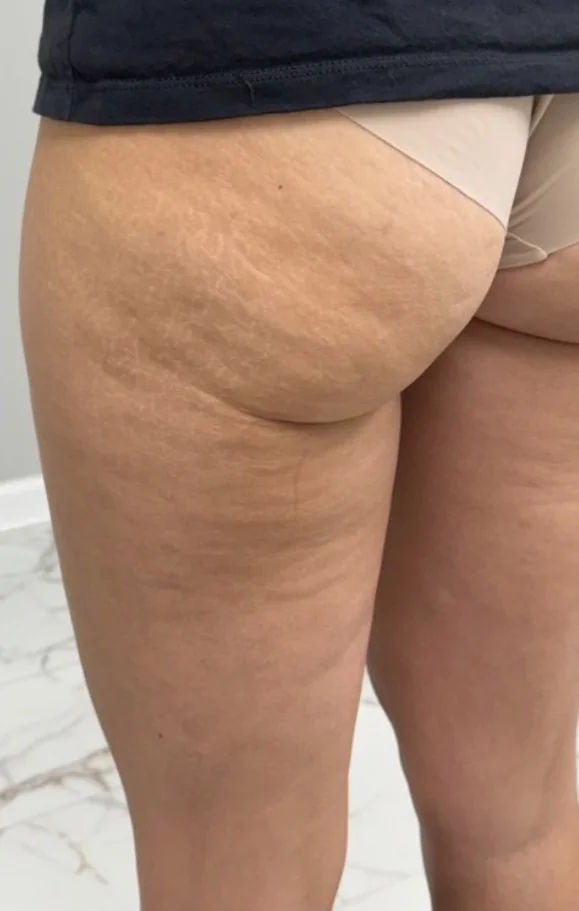 Thigh and buttock after one Onda Pro treatment, side view