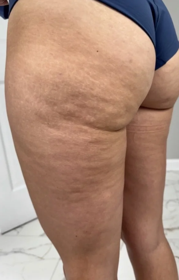 Thigh and buttock before one Onda Pro treatment, side view