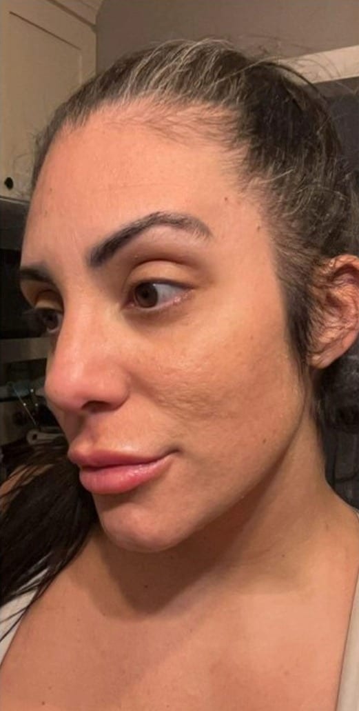 Facial skin tone before and after peel series