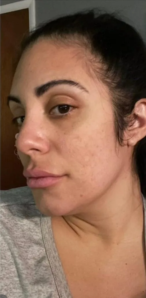 Facial skin tone before peel series