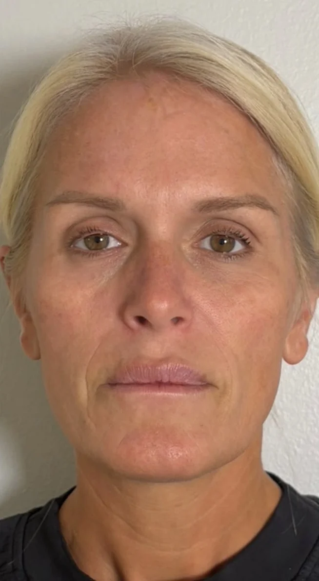 Full face after a series of CoolPeel CO2 laser treatments, front view