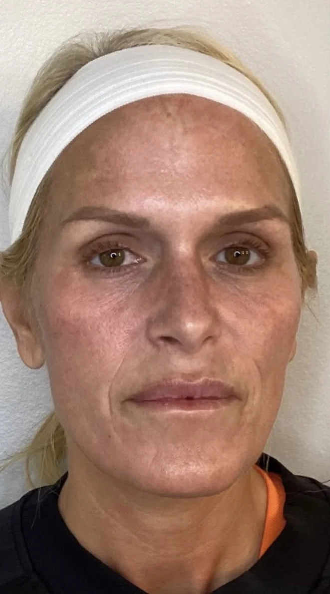 Full face before a series of CoolPeel CO2 laser treatments, front view