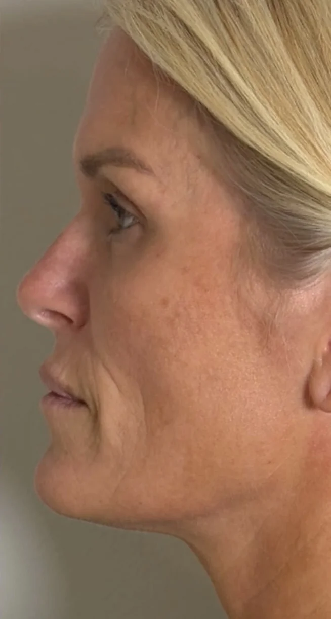 Face in left profile after a series of CoolPeel CO2 laser treatments