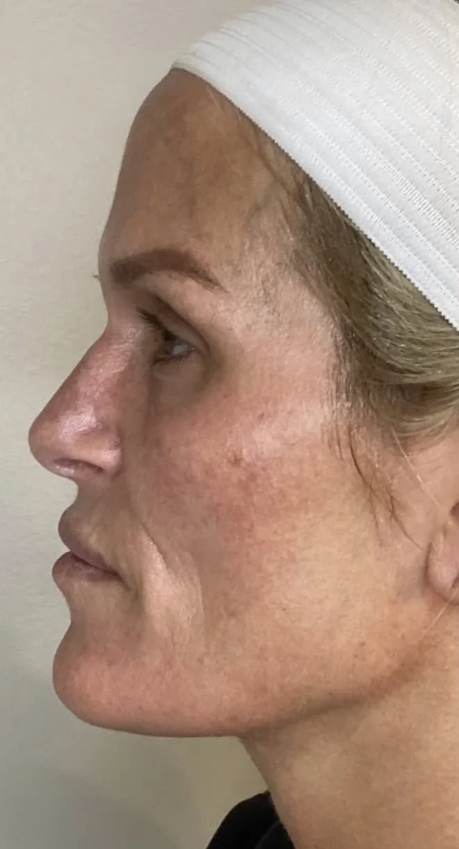 Face in left profile before a series of CoolPeel CO2 laser treatments