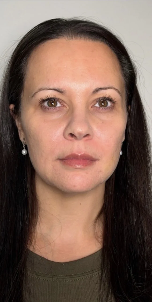 Full face after subtle facial balancing with hyaluronic acid filler, front view