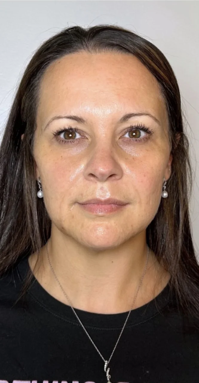 Full face before subtle facial balancing with hyaluronic acid filler, front view