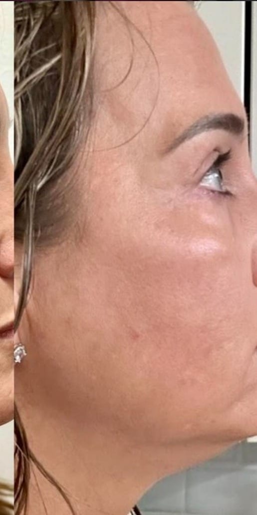 Cheek texture before and after Morpheus8 resurfacing series