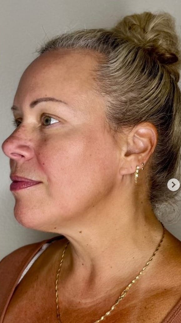 Profile before and after facial balancing treatment