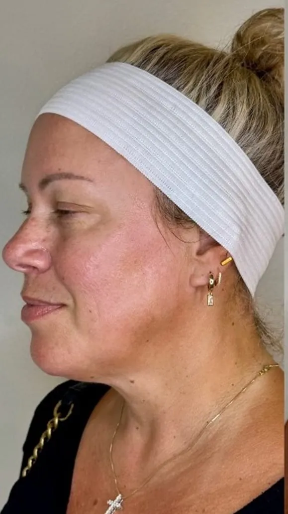 Profile before facial balancing treatment