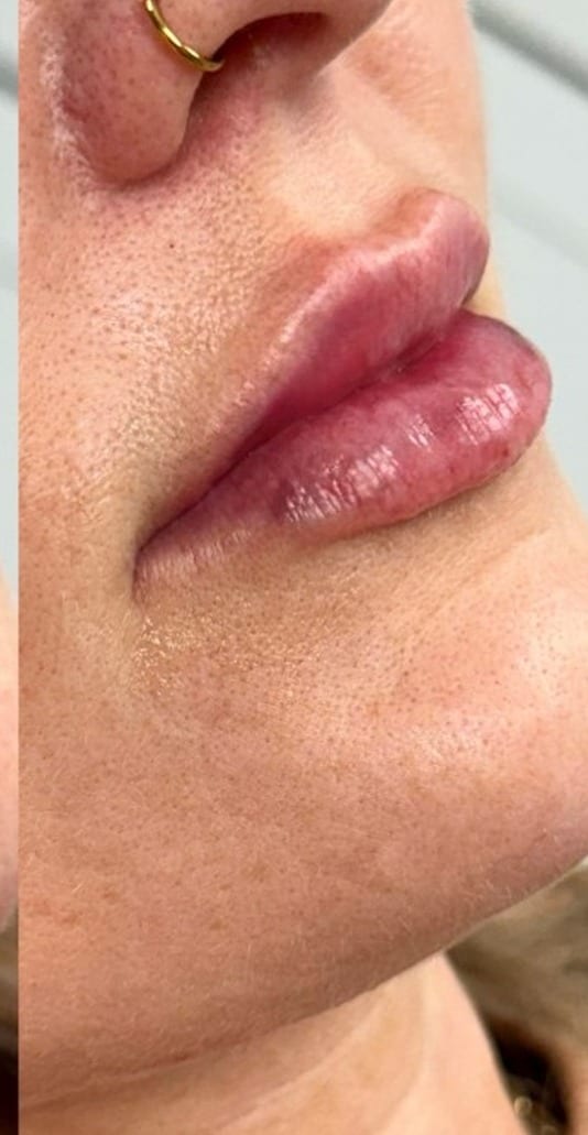 Lips before and after filler, side view