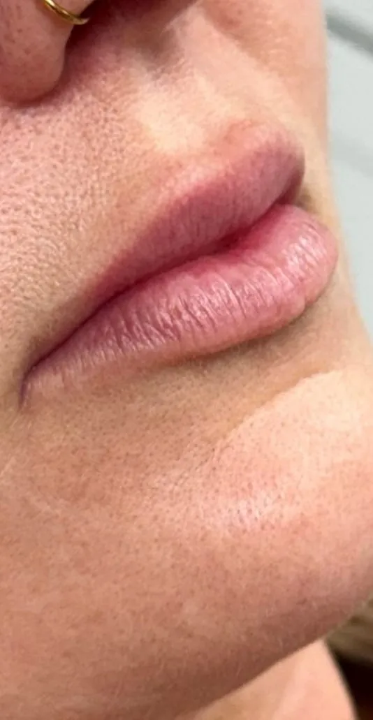 Lips before filler, side view