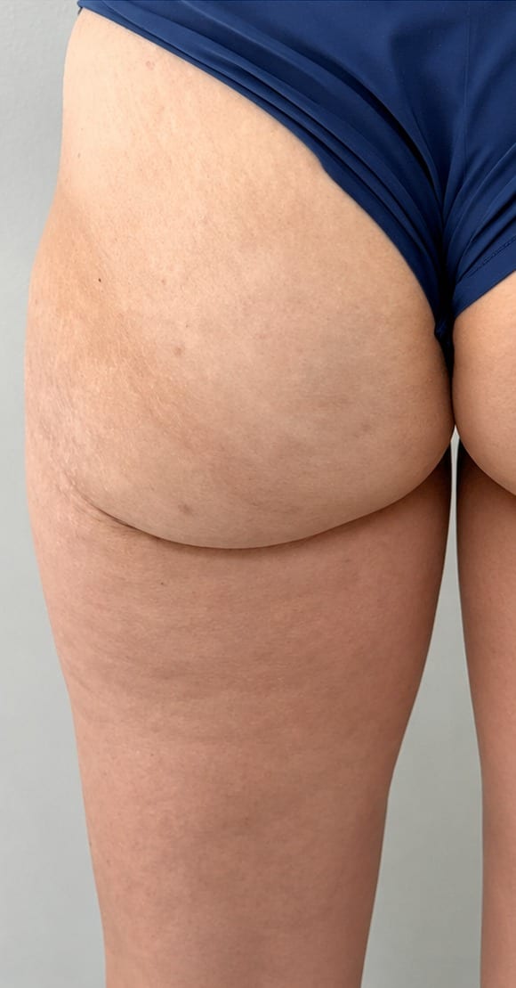 Posterior thighs before and after body contouring series