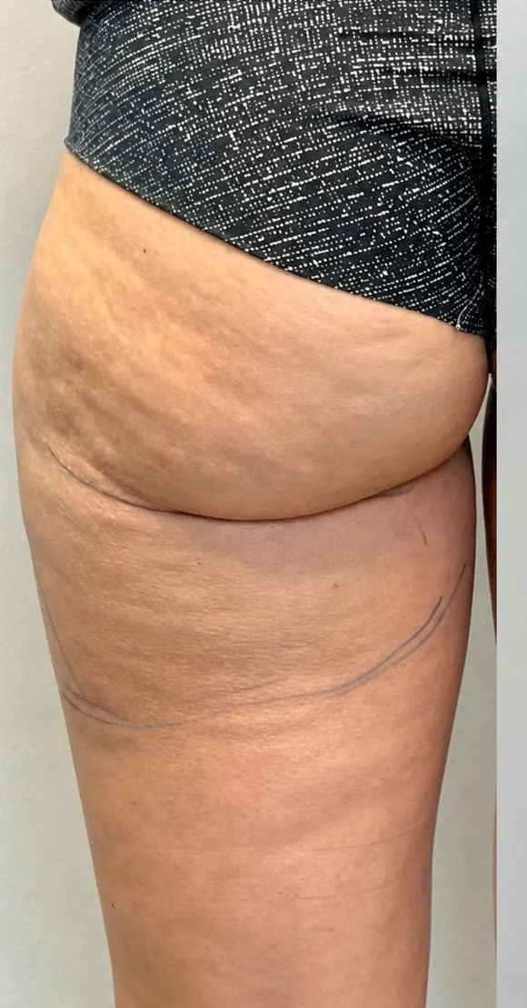 Posterior thighs before body contouring series