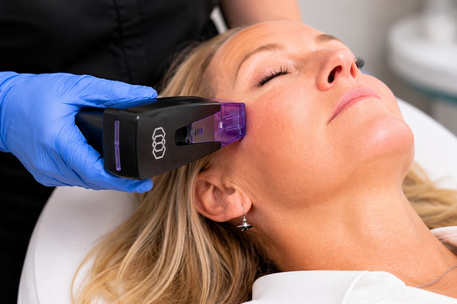 Morpheus8 radiofrequency microneedling treatment